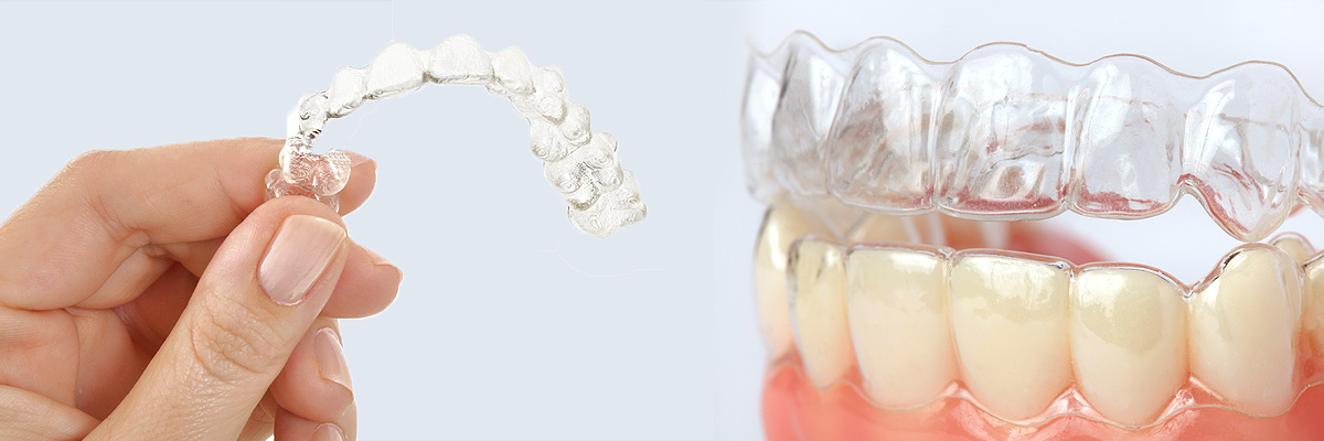 El Centro Alternative to Braces for Teens