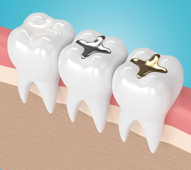El Centro Tooth Colored Fillings