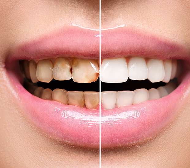 El Centro Dental Implant Restoration