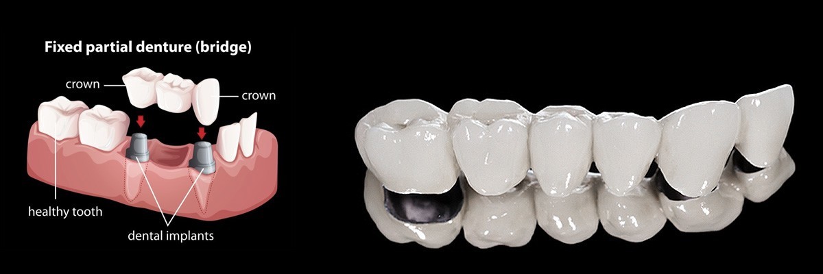El Centro Dentures