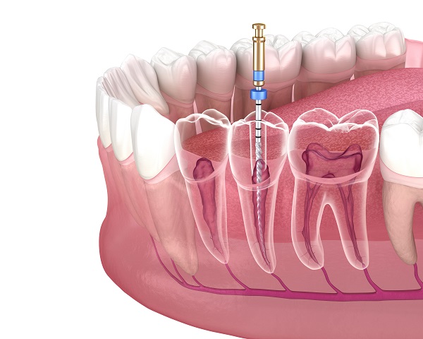 What Are The Most Common Endodontic Procedures?