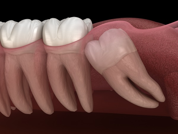 wisdom tooth extraction El Centro, CA